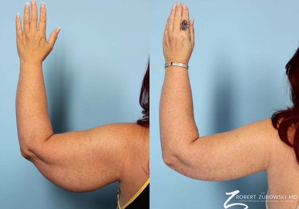 Arm Lift - Case 3502