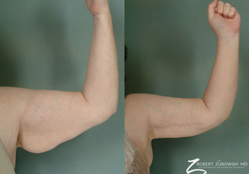 Arm Lift - Thumbnail 3