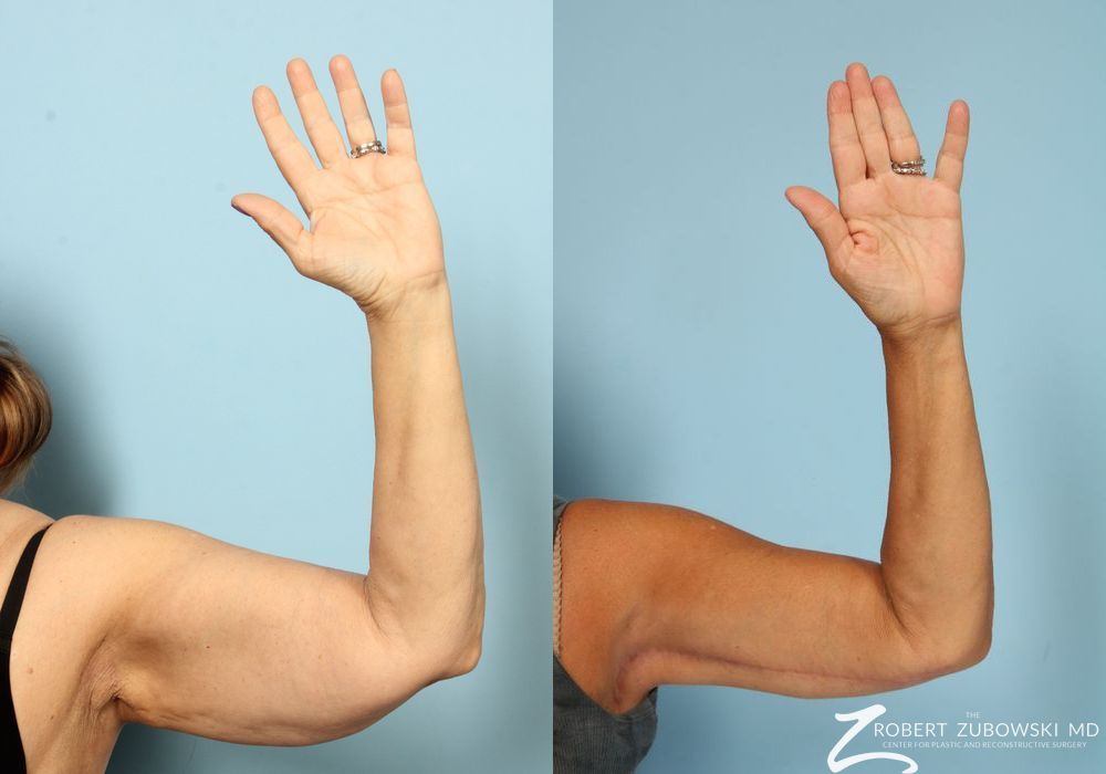 Arm Lift - Thumbnail 2