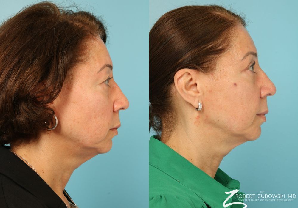 Blepharoplasty - Thumbnail 2