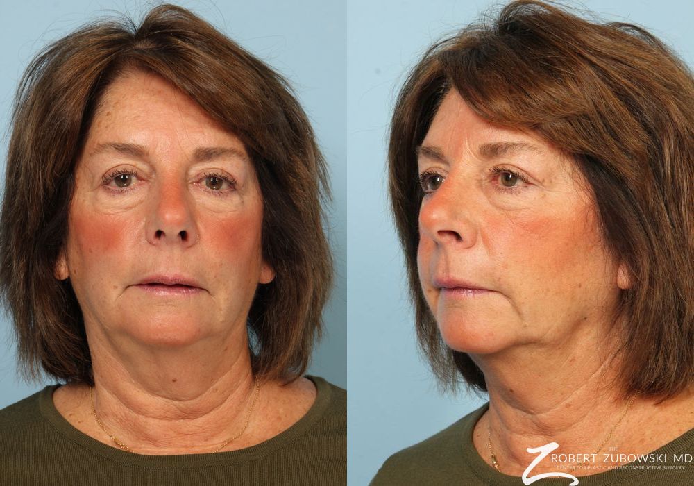 Blepharoplasty - Thumbnail 2