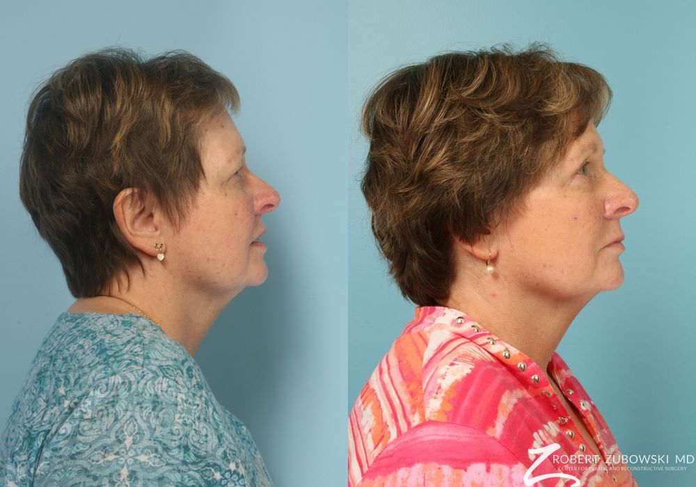 Blepharoplasty - Thumbnail 2