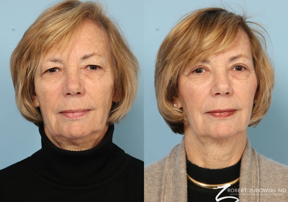 Blepharoplasty - Case 3756