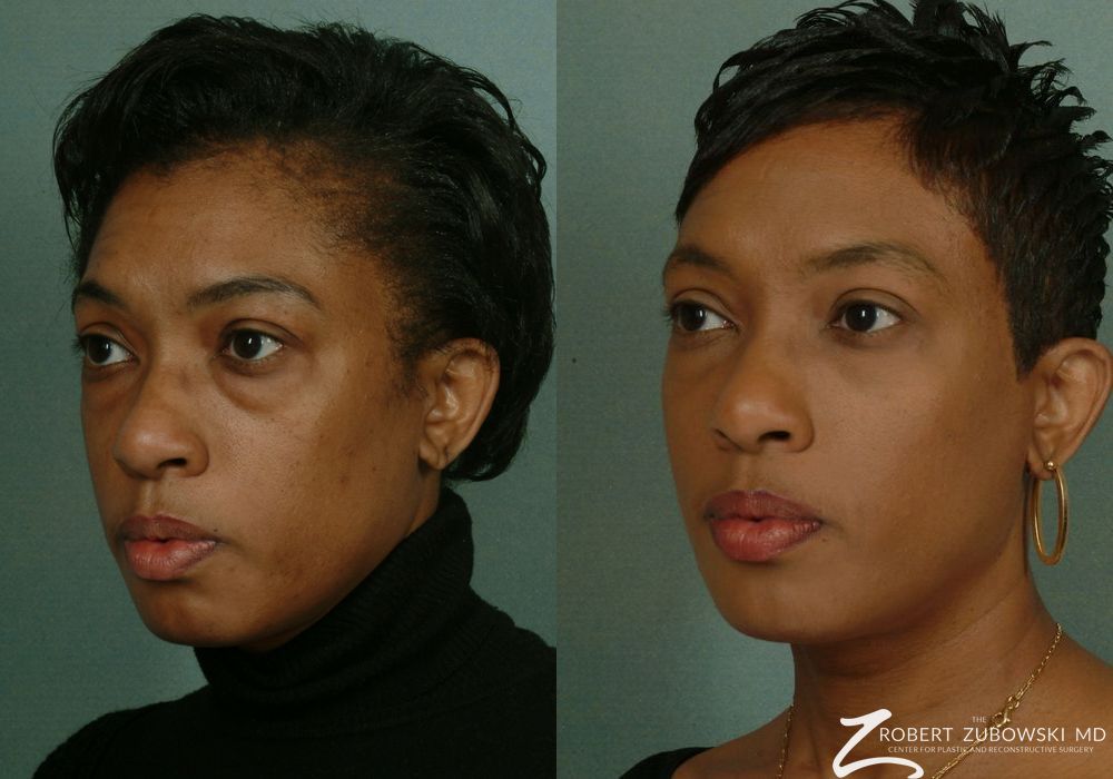 Blepharoplasty - Thumbnail 2