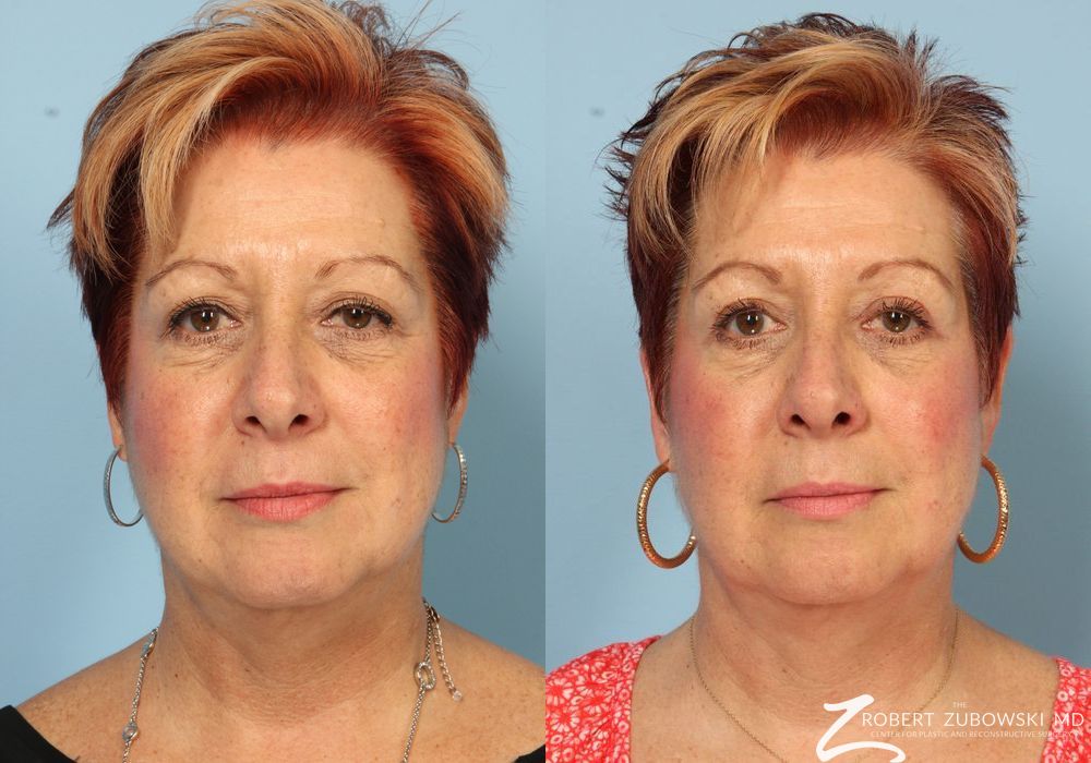 Blepharoplasty - Case 3776