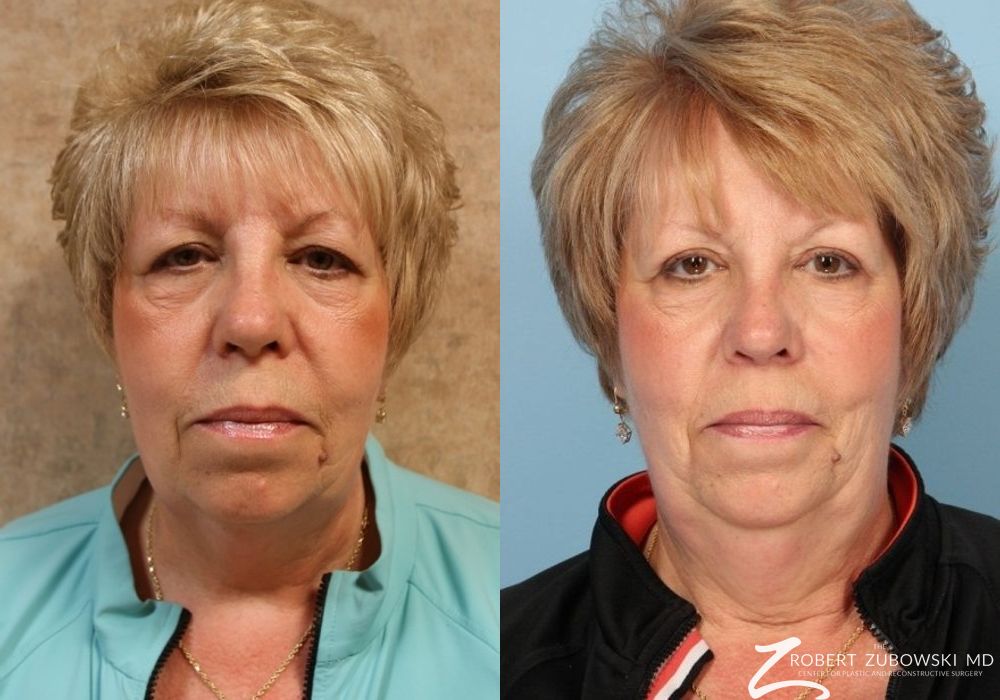 Blepharoplasty - Case 3772
