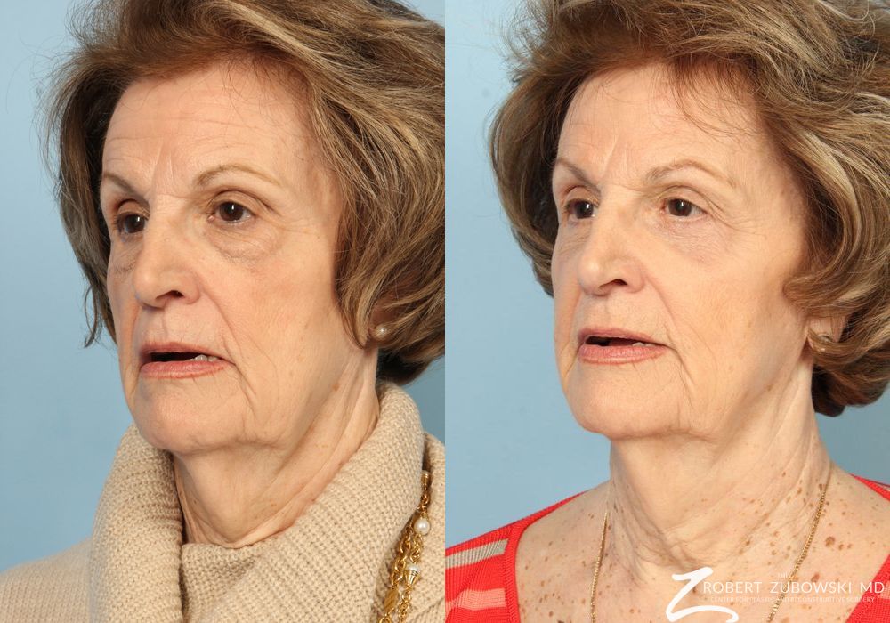 Blepharoplasty - Thumbnail 2