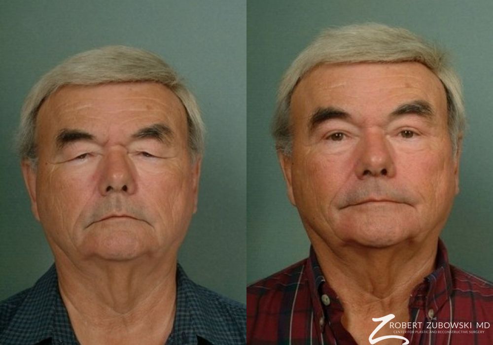 Blepharoplasty - Case 3737