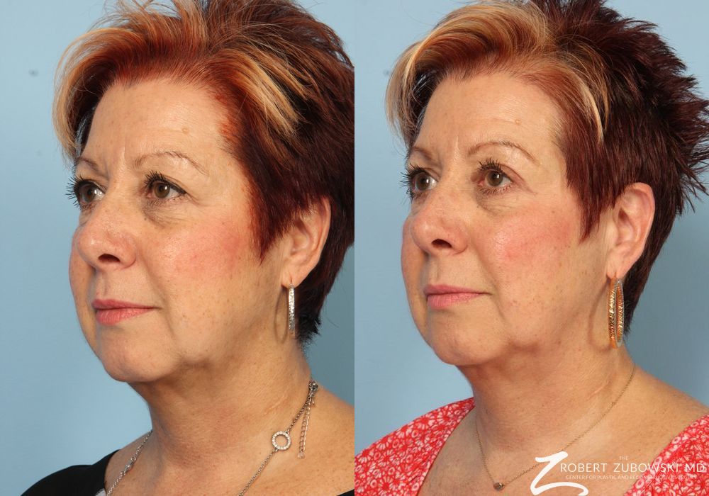 Blepharoplasty - Thumbnail 2