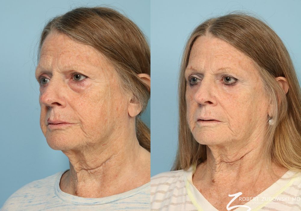 Blepharoplasty - Thumbnail 2