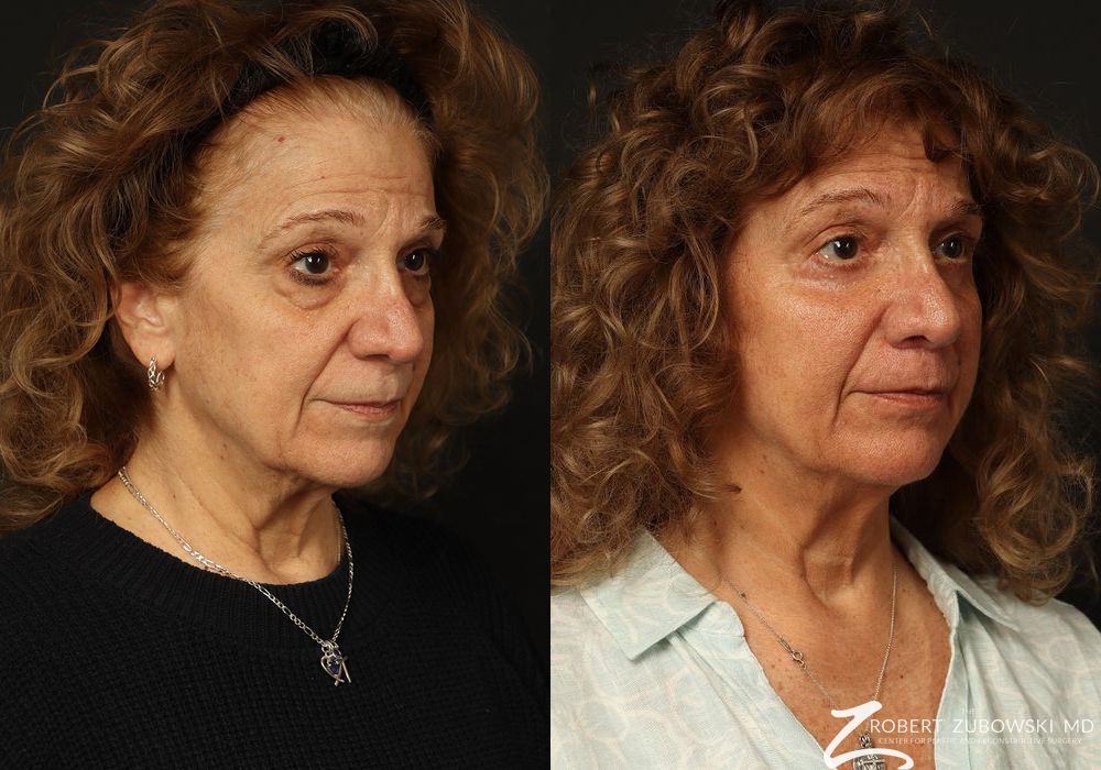 Blepharoplasty - Thumbnail 3