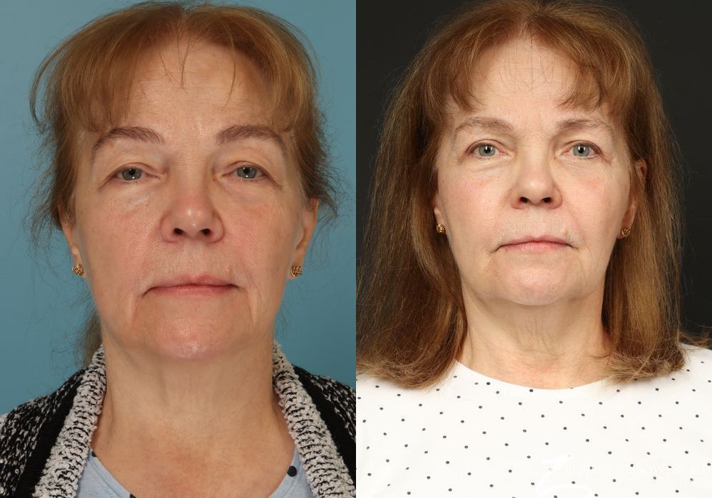 Blepharoplasty - Case 3765