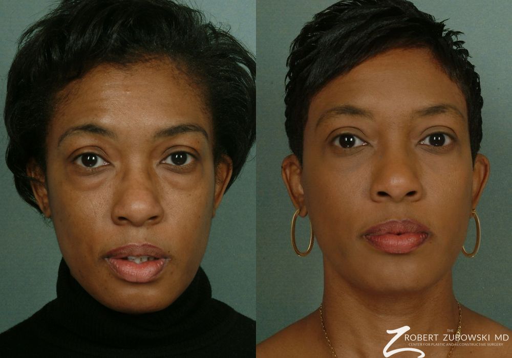 Blepharoplasty - Case 3741
