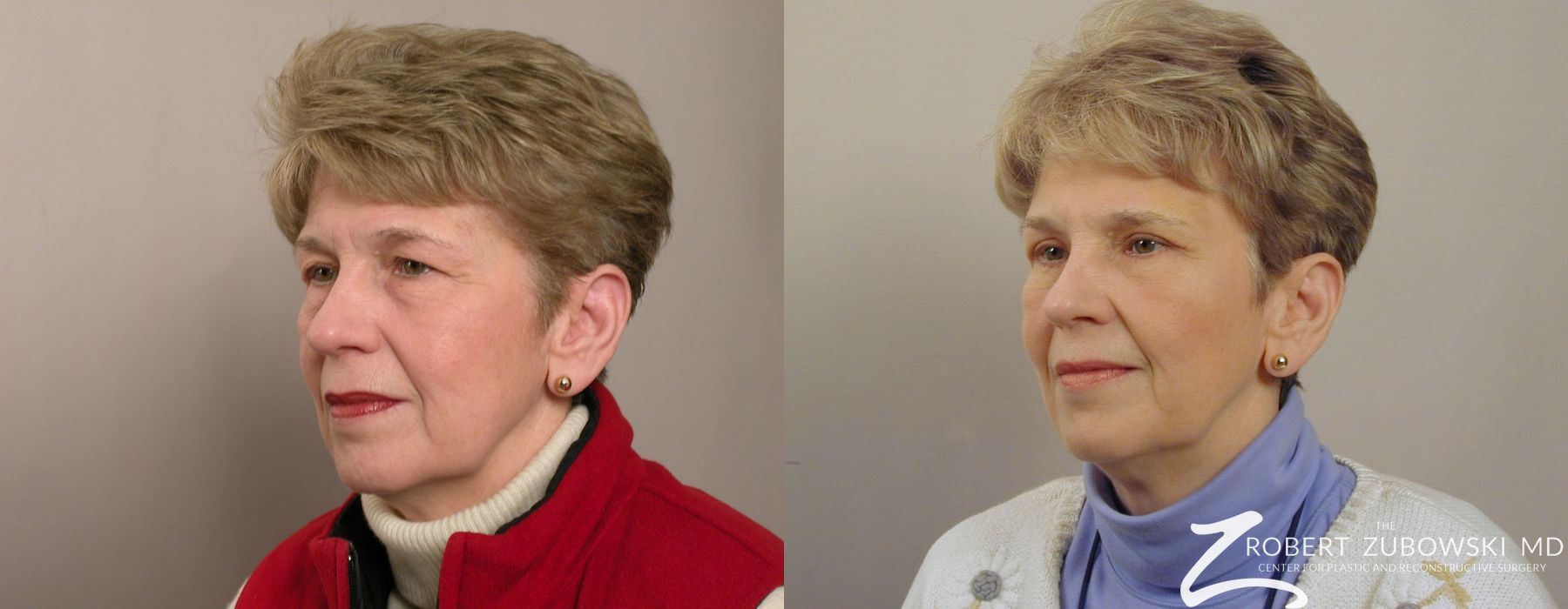 Blepharoplasty - Thumbnail 2