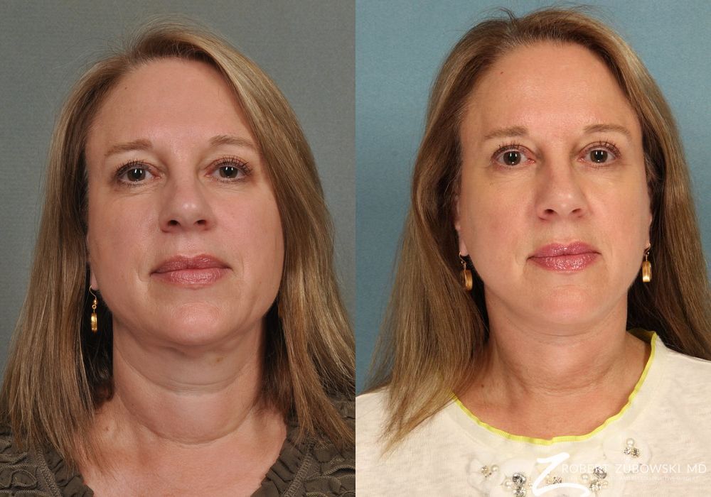 Blepharoplasty - Case 3774