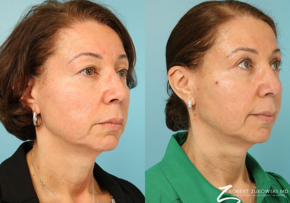 Blepharoplasty - Thumbnail 3