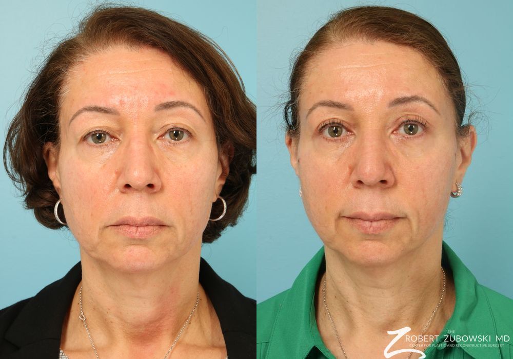 Blepharoplasty - Case 3777