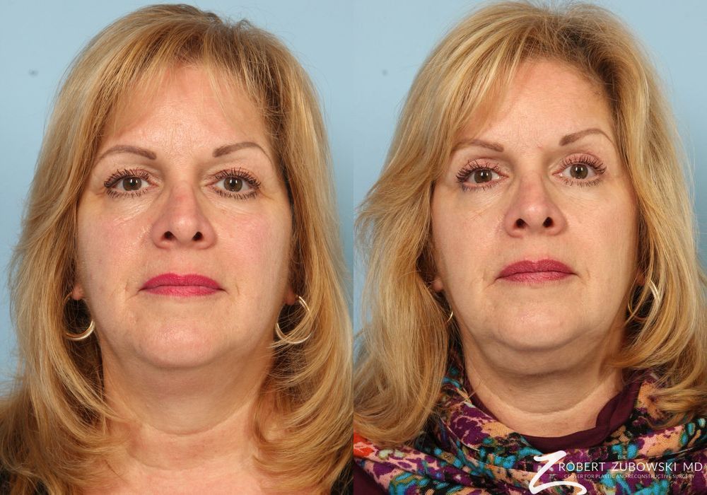 Blepharoplasty - Case 3759
