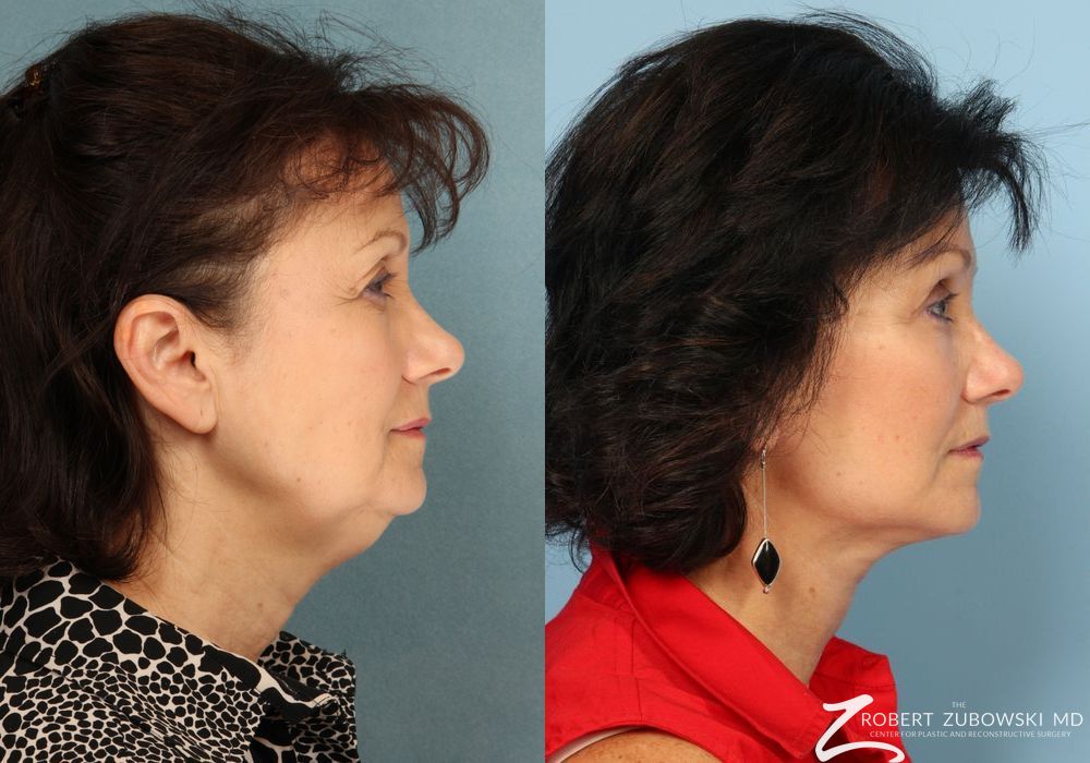 Blepharoplasty - Thumbnail 2