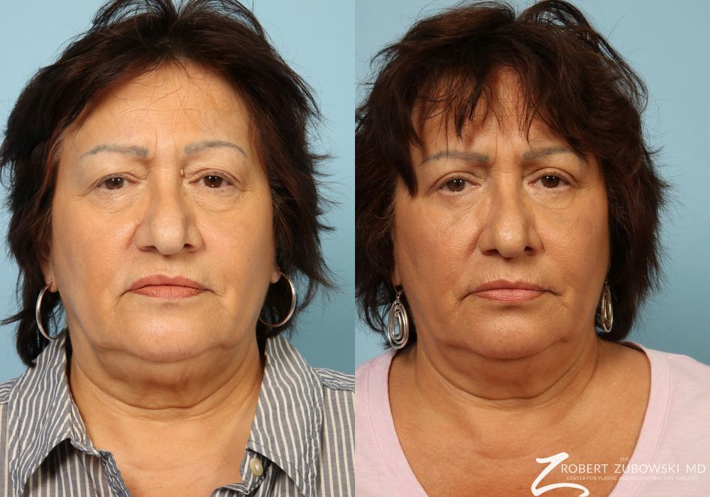 Blepharoplasty - Case 3778