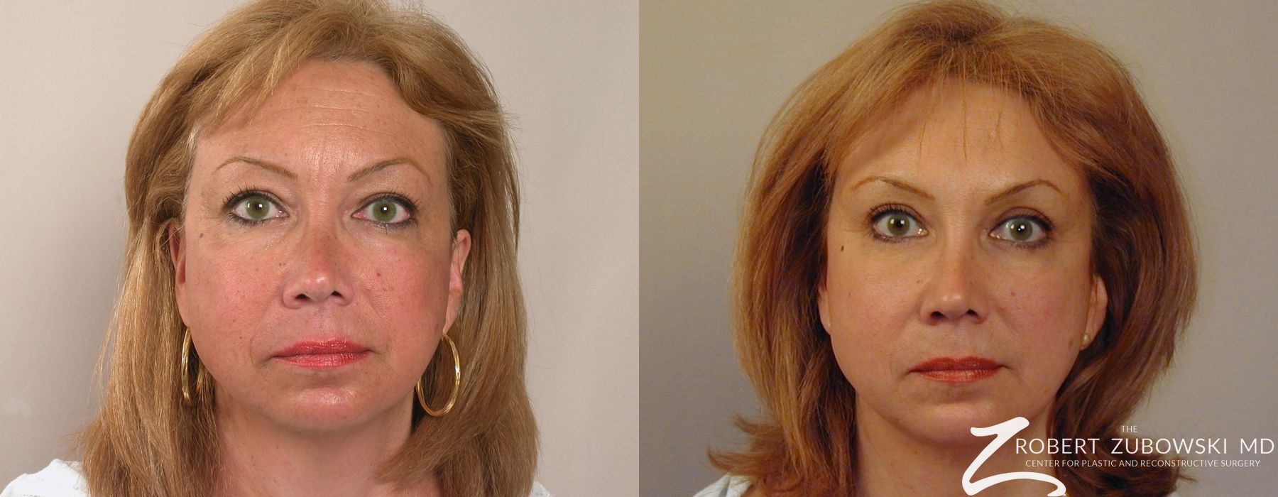 Blepharoplasty - Case 3766
