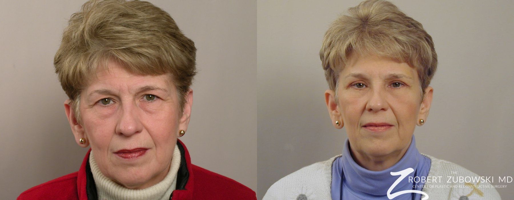 Blepharoplasty - Case 3763