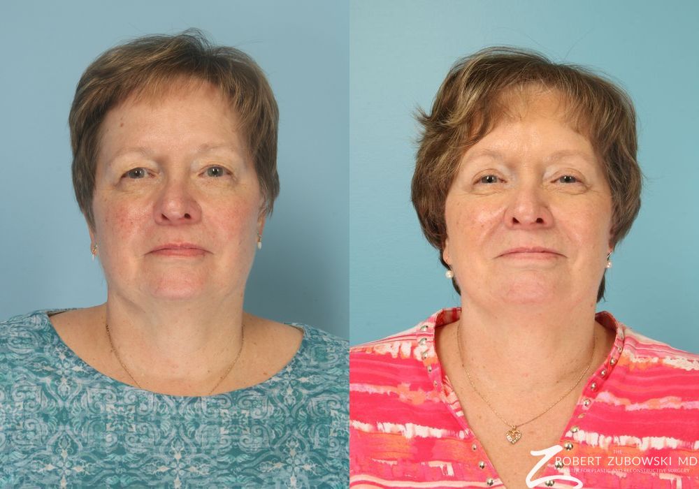 Blepharoplasty - Case 3764