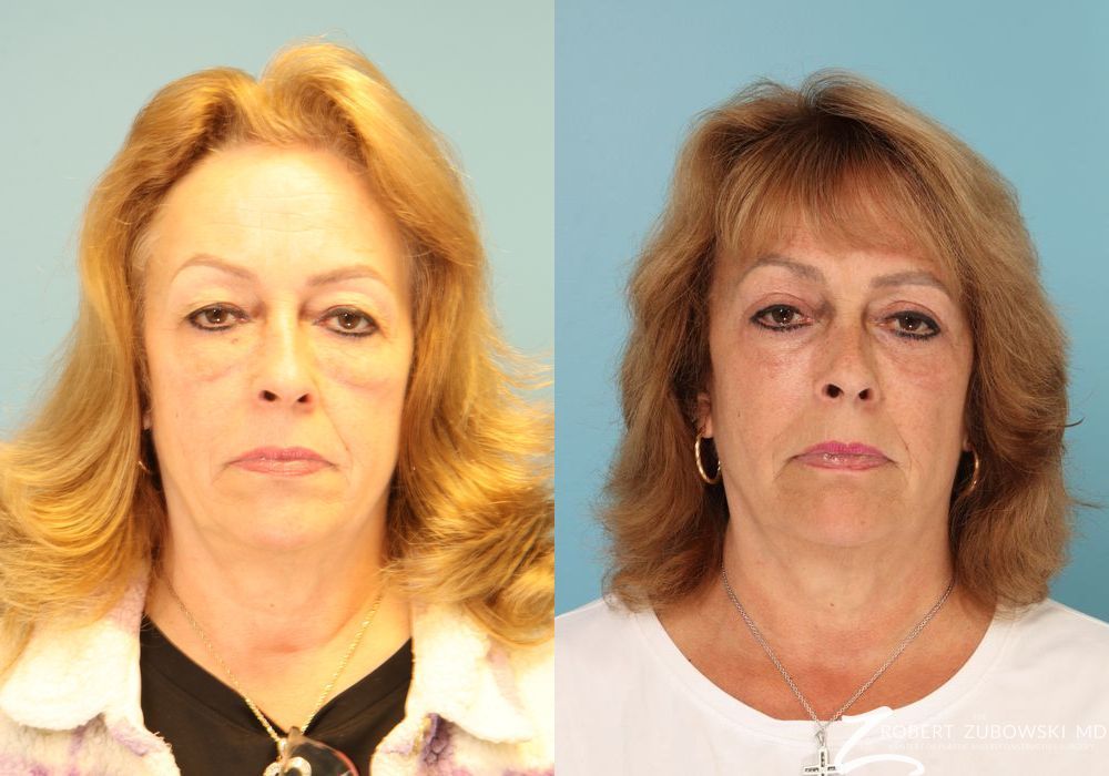 Blepharoplasty - Case 3770