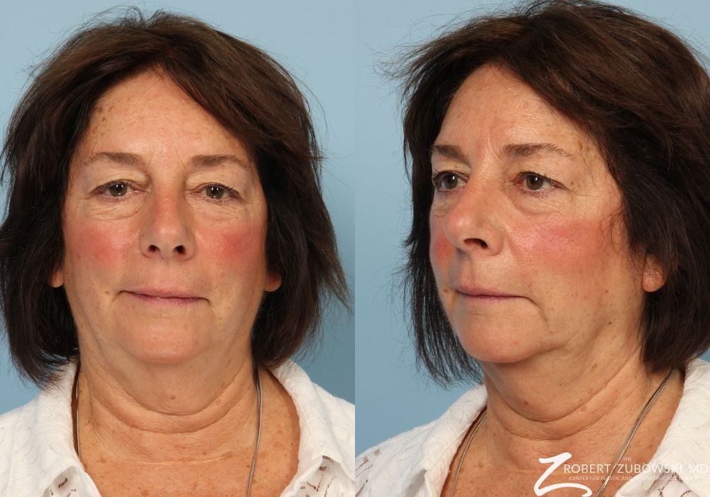 Blepharoplasty - Case 3769
