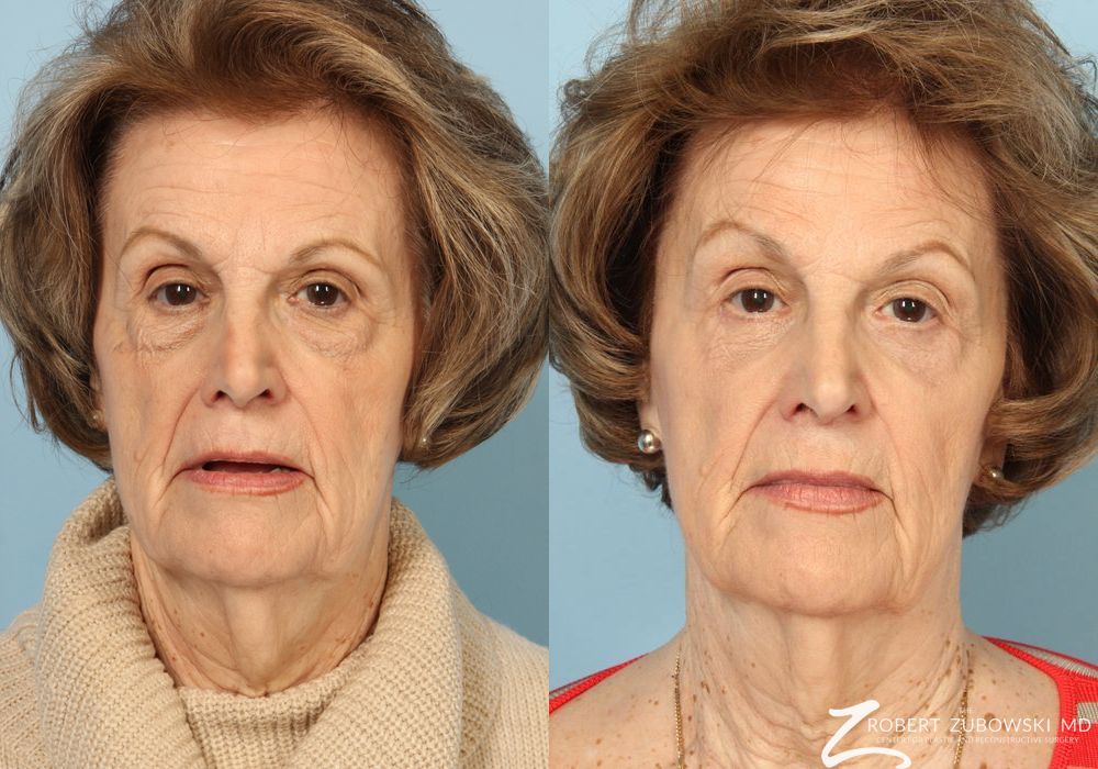 Blepharoplasty - Case 3761