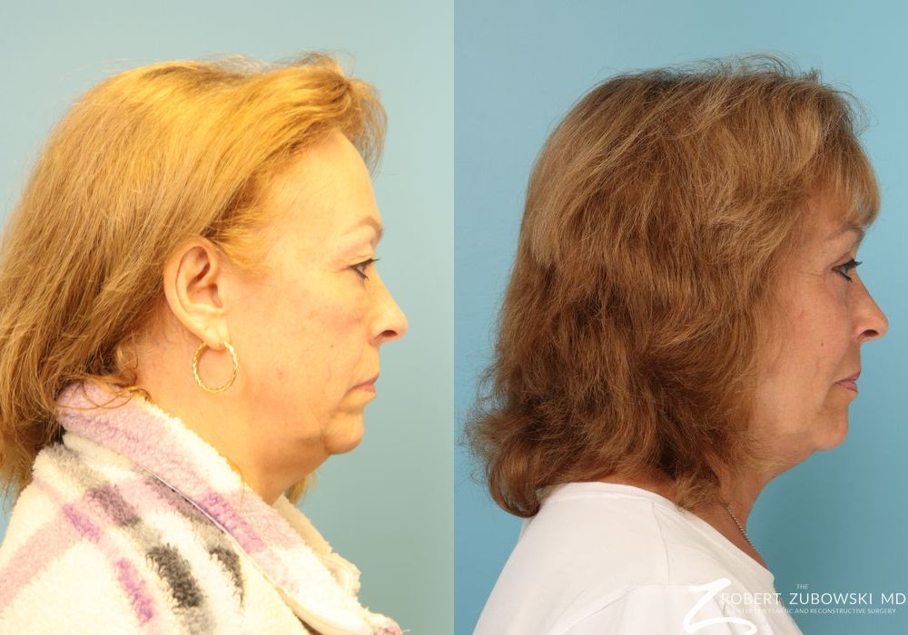 Blepharoplasty - Thumbnail 2