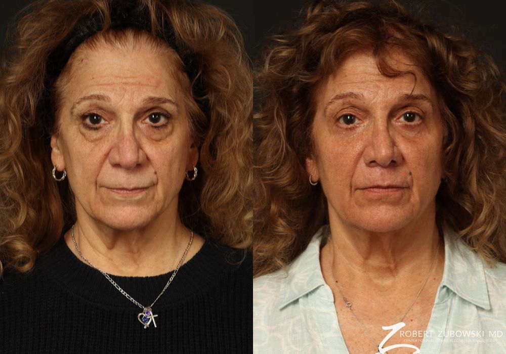 Blepharoplasty - Case 3780