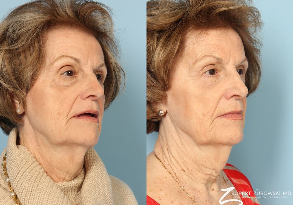 Blepharoplasty - Thumbnail 3