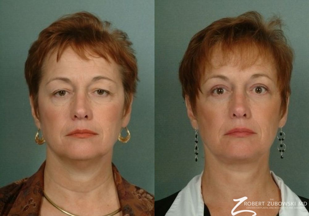 Blepharoplasty - Case 3773