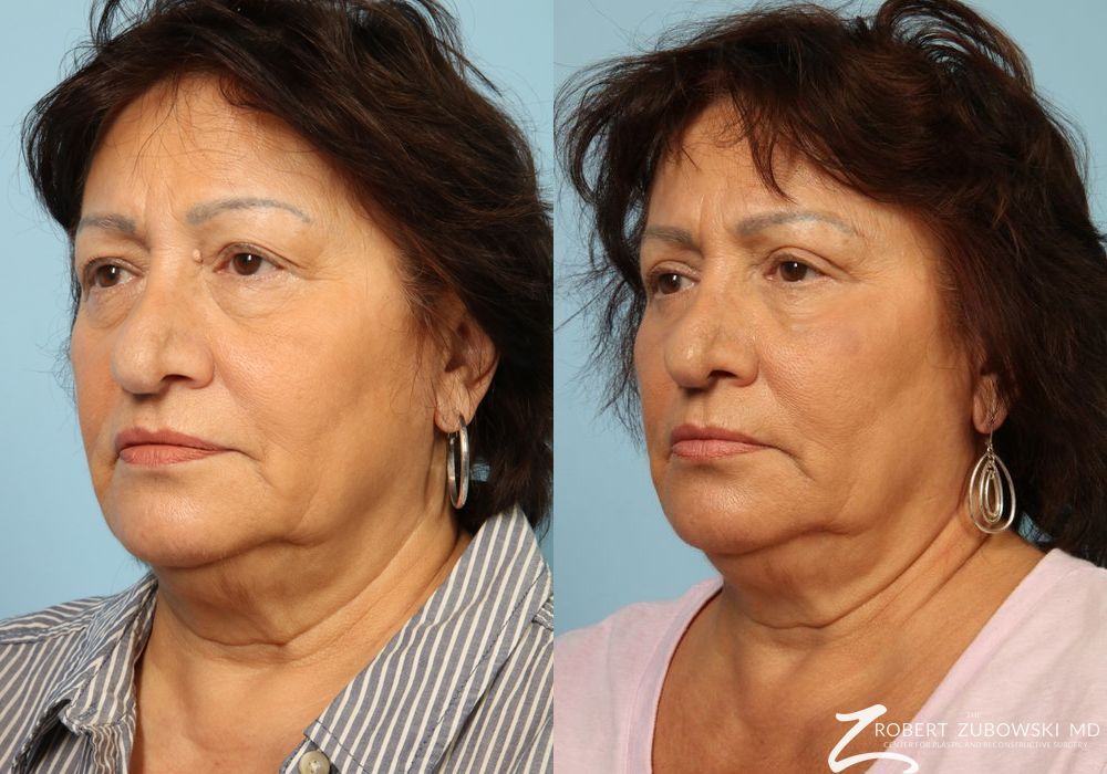 Blepharoplasty - Thumbnail 2