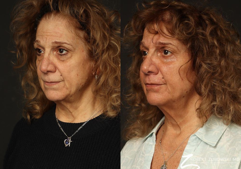 Blepharoplasty - Thumbnail 2