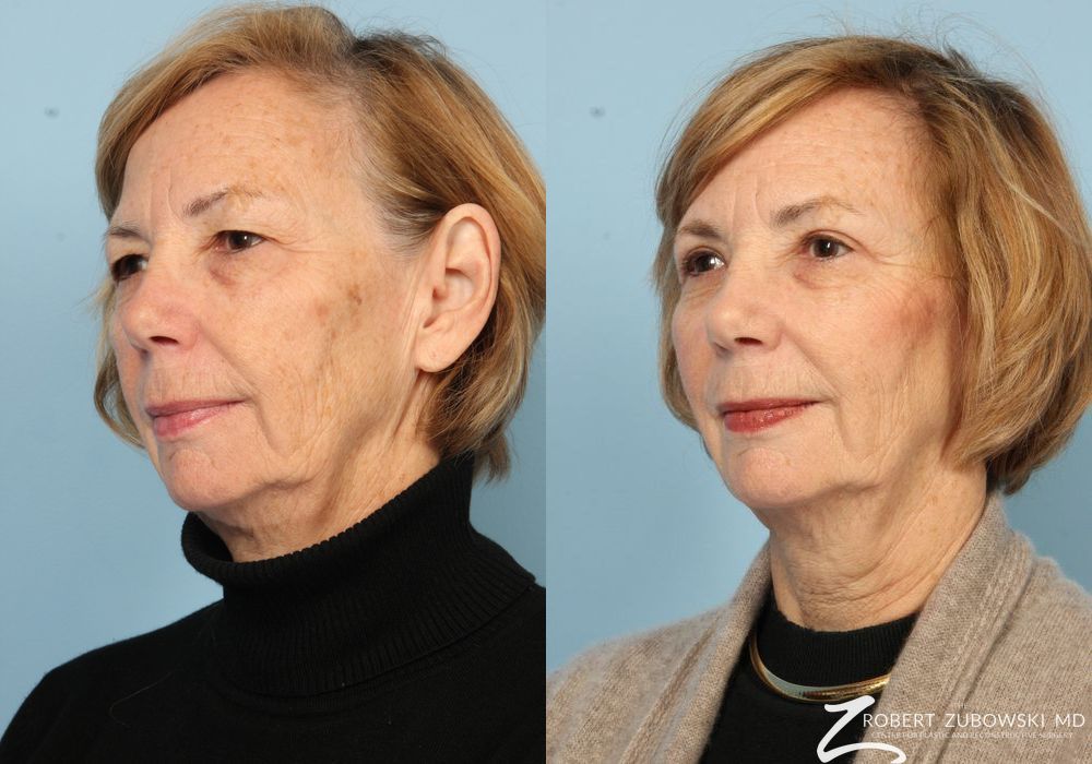 Blepharoplasty - Thumbnail 2