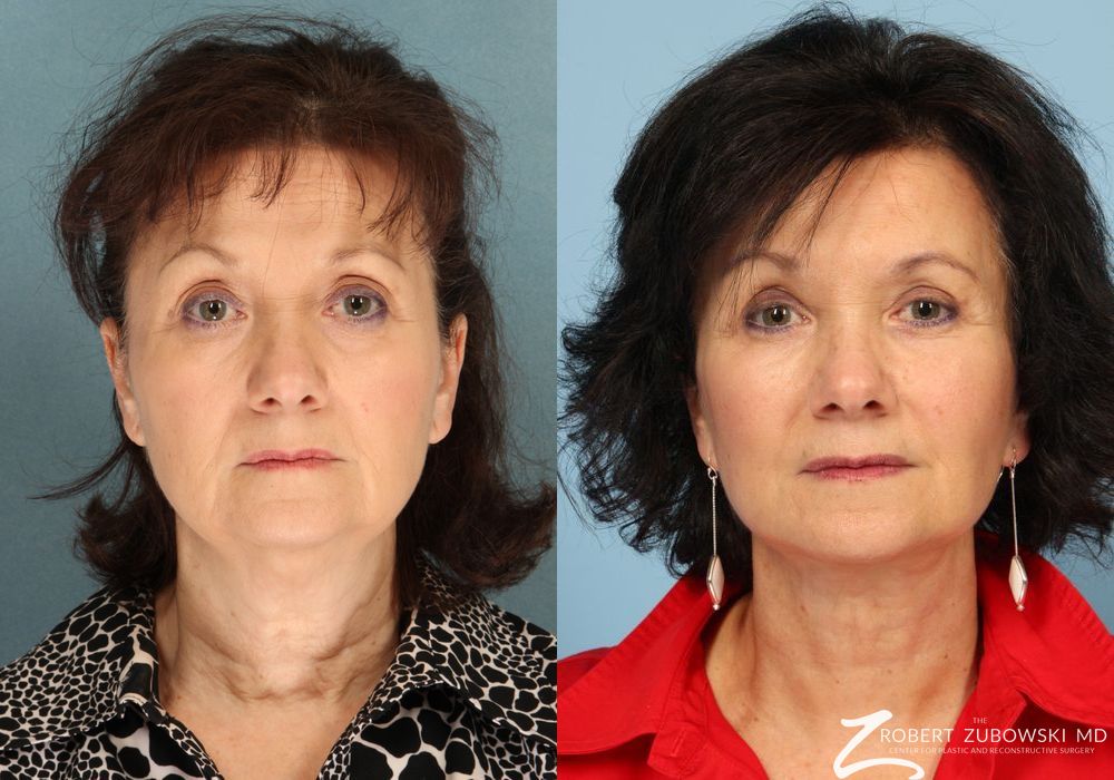 Blepharoplasty - Case 3767