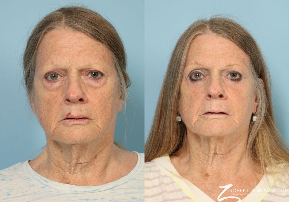 Blepharoplasty - Case 3762