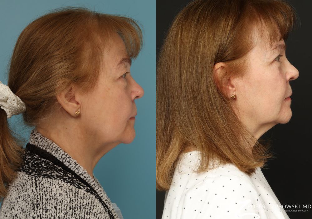 Blepharoplasty - Thumbnail 2