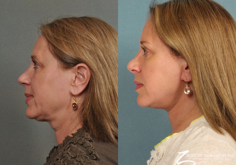 Blepharoplasty - Thumbnail 2