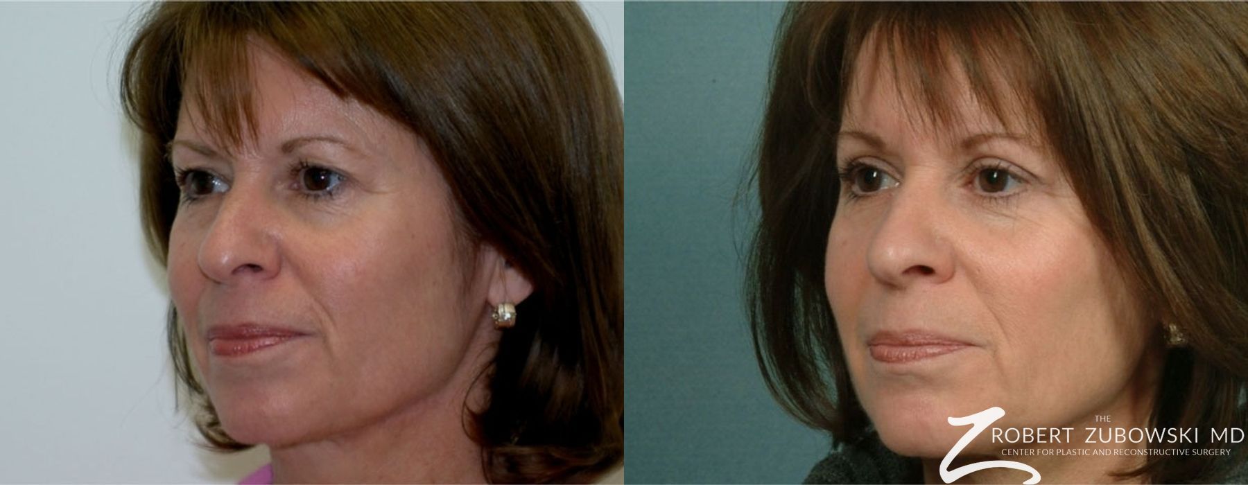 Blepharoplasty - Case 3768
