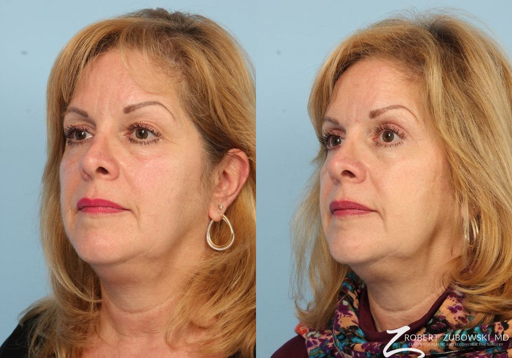 Blepharoplasty - Thumbnail 2
