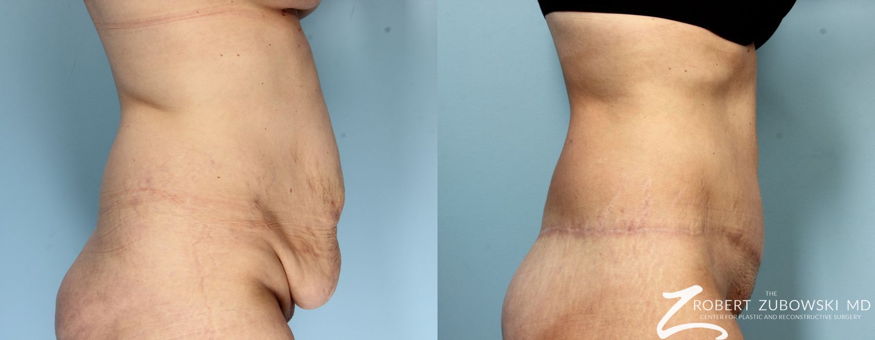 Body Lift - Thumbnail 3