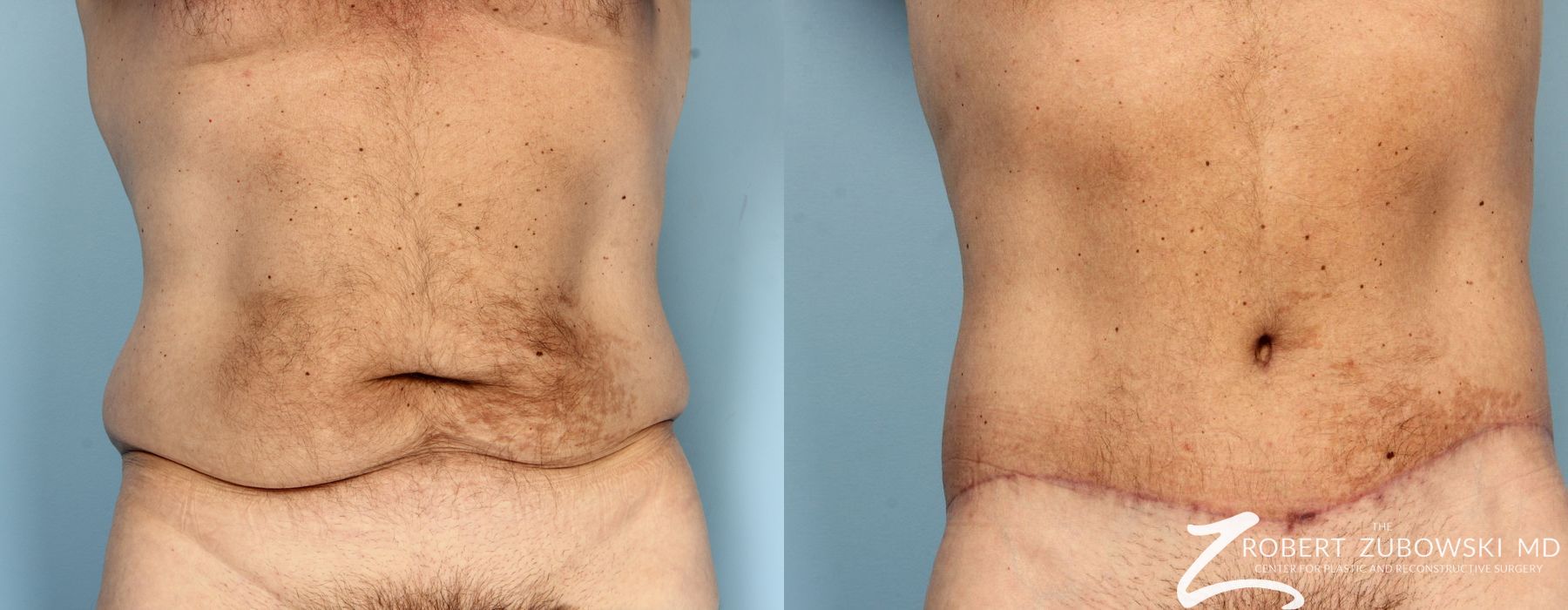 Body Lift - Case 3511