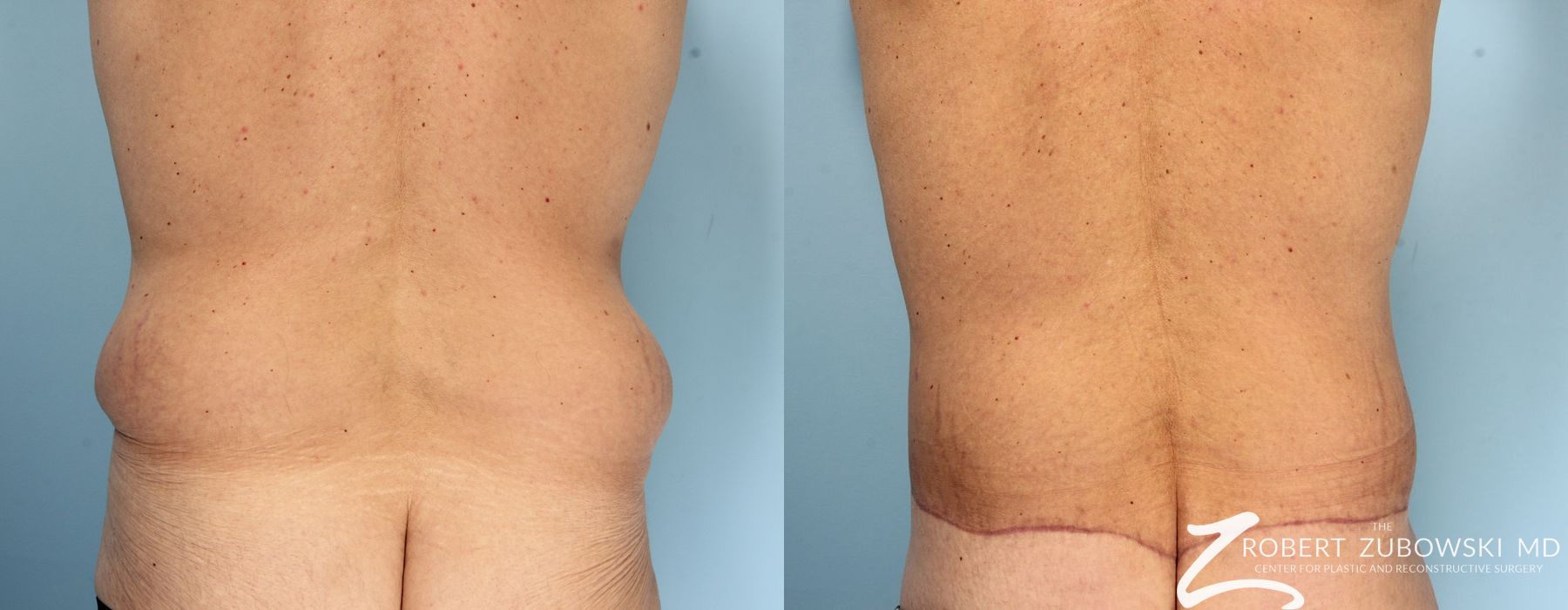 Body Lift - Thumbnail 2