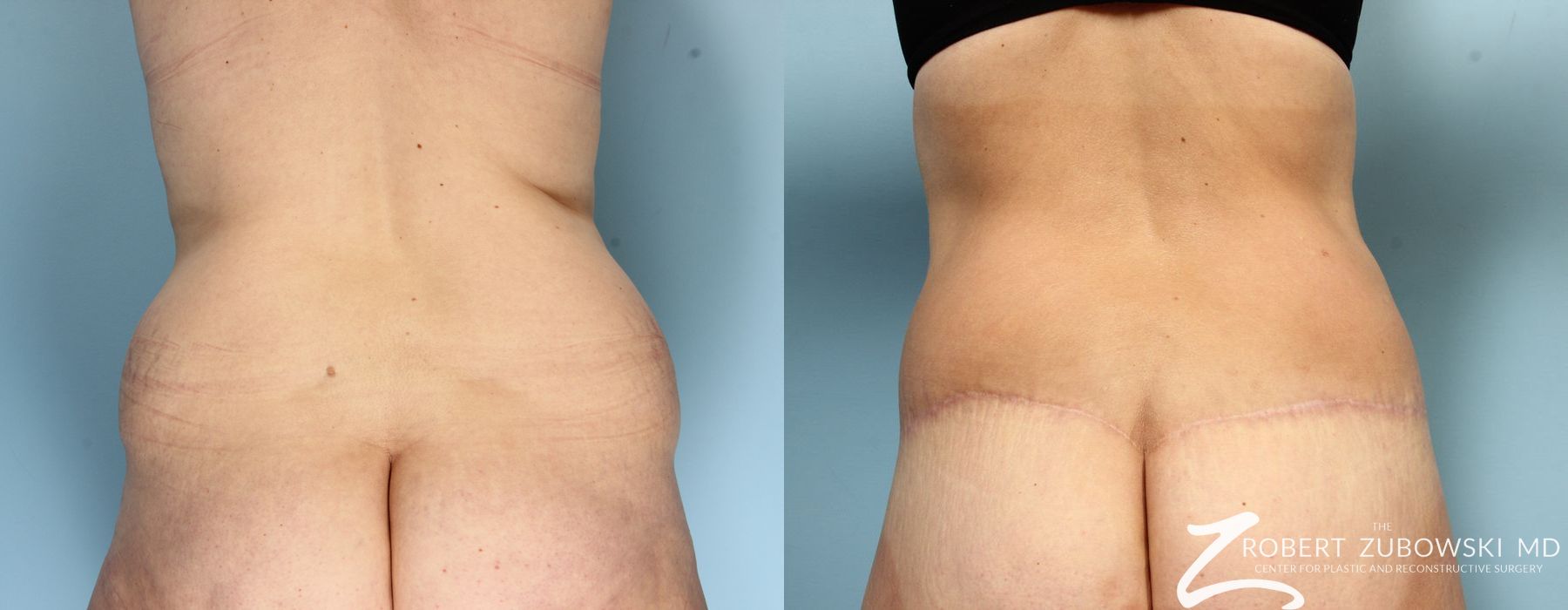 Body Lift - Thumbnail 2