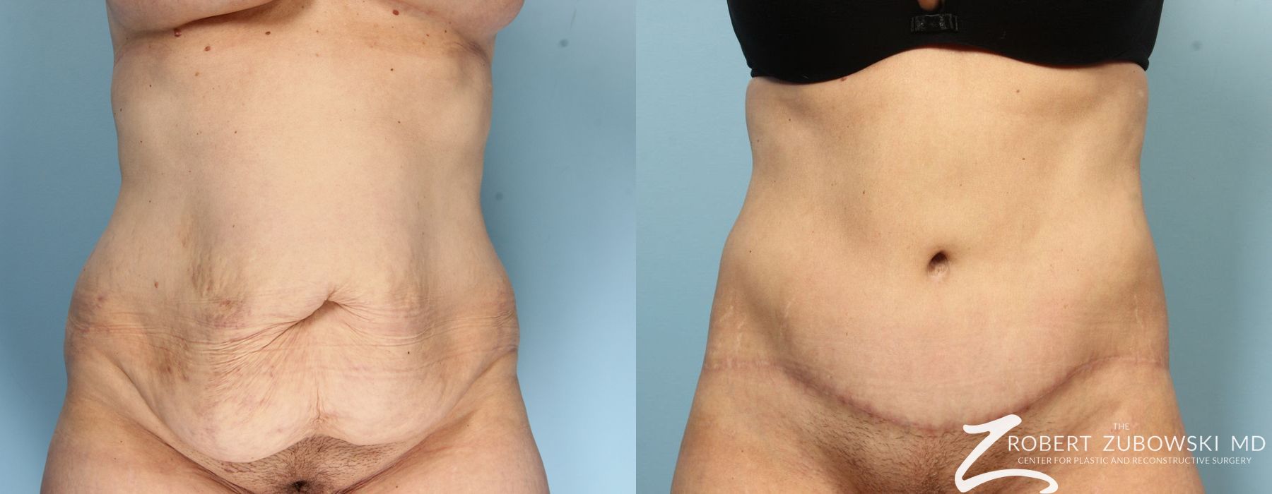 Body Lift - Case 3512