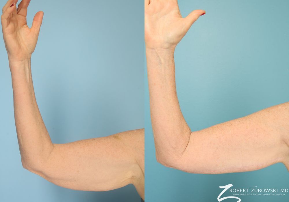 Brachioplasty - Case 3517