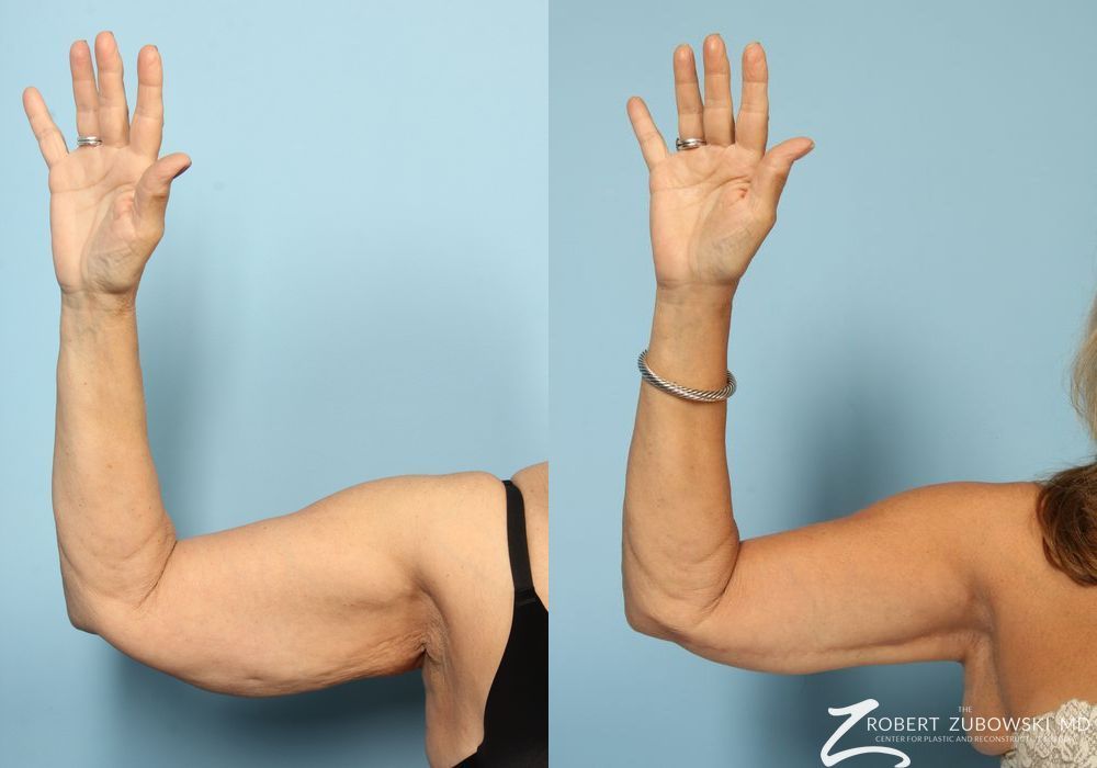 Brachioplasty - Case 3516